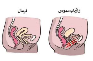 واژینیسم